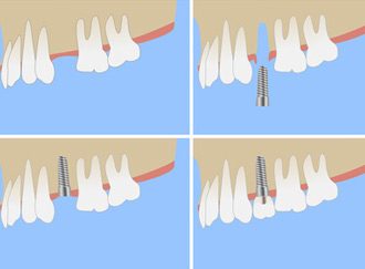 Implantate Kiefer