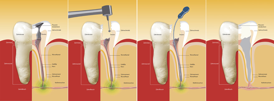 Wurzelbehandlung
